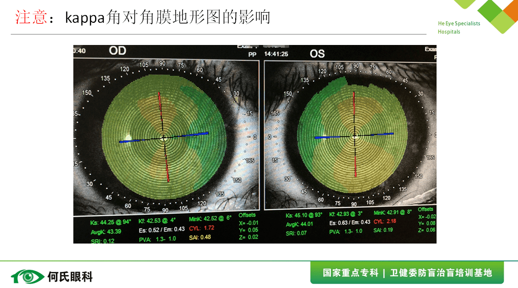 eyehealthdoctor關愛視覺健康,呵護心靈之窗角膜地形圖在塑形鏡中的