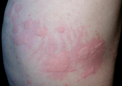 胆碱能性荨麻疹,由于过敏源刺激导致人体的免疫功能紊乱,使体内免疫球