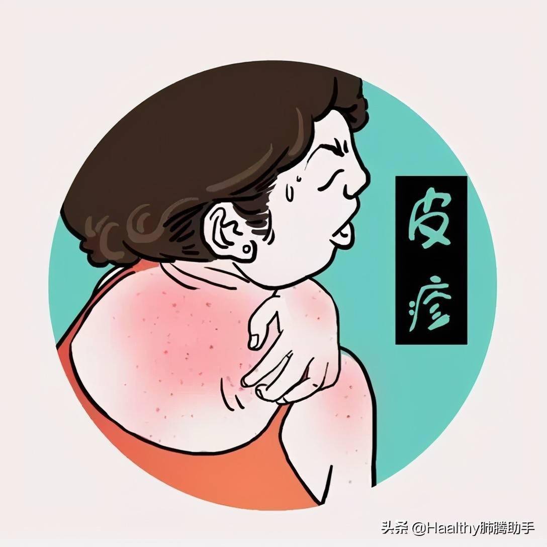 皮疹用什么药物治疗 9fc7077e76c948cc926b2f3034fde9a3.jpeg