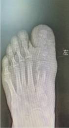 伤口|一根小铁钉“蛀”空大脚趾