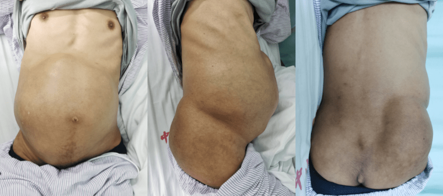 年成|养瘤三年成“巨患”，广州医生妙手摘除12公斤中骨盆肿瘤