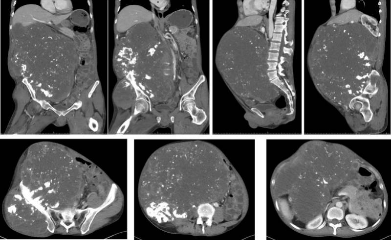 年成|养瘤三年成“巨患”，广州医生妙手摘除12公斤中骨盆肿瘤