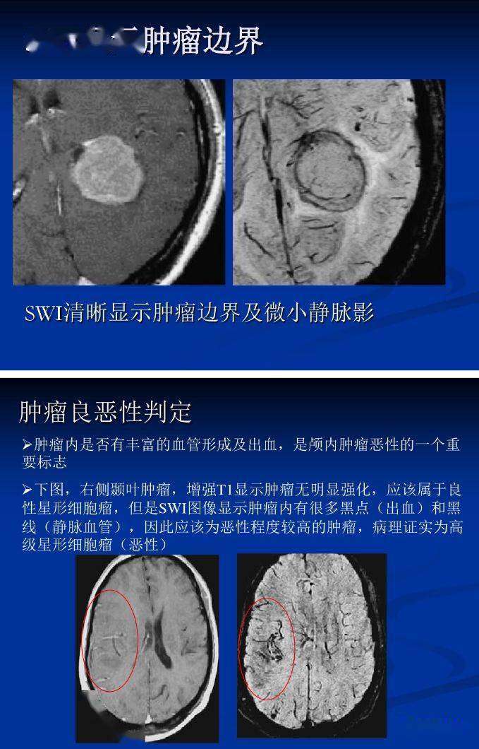 swi在显示脑内小静脉及出血方面敏感