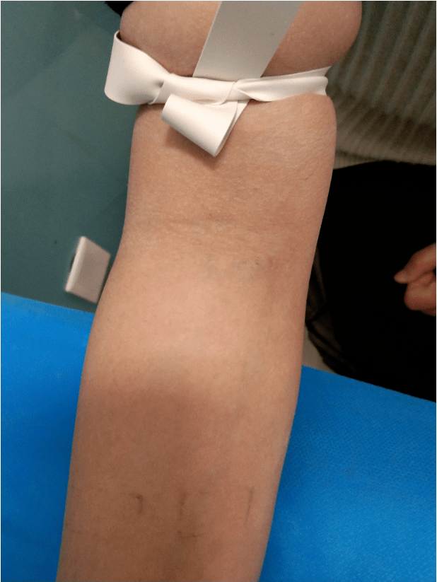 笔者对96例患者进行调查,其中只有24名患者将衣服弄到系止血带的上方