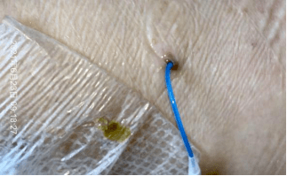 picc穿刺点并发淋巴漏液如何处理病例回顾