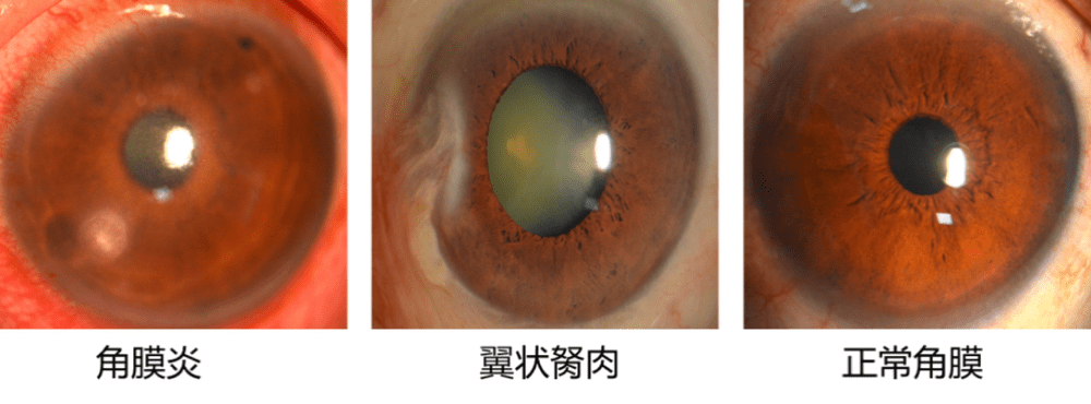 陳蔚團隊人工智能角膜盲防控系統研究發表於自然雜誌子刊自然通訊