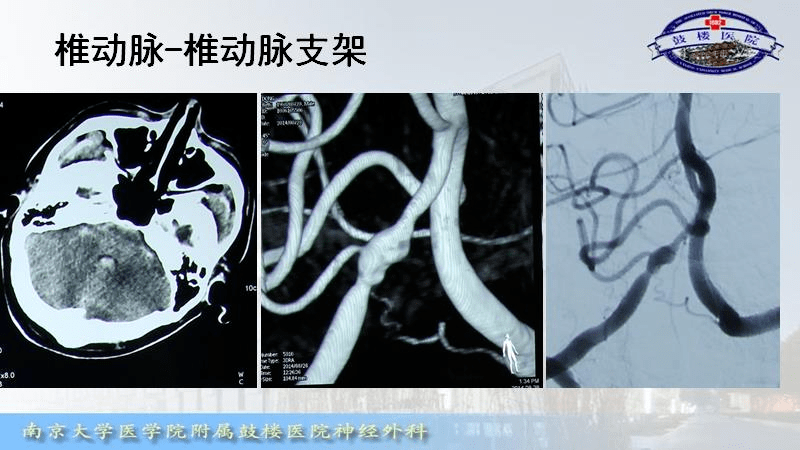 神介骑士论坛第12期精华回顾出血性椎动脉夹层动脉瘤的介入治疗