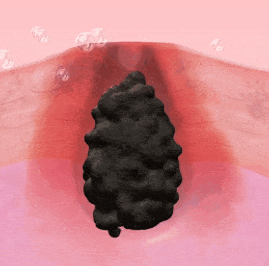 黑头,是皮肤油脂分泌过剩,混杂了其他污物堵塞在毛孔里,氧化后变黑变