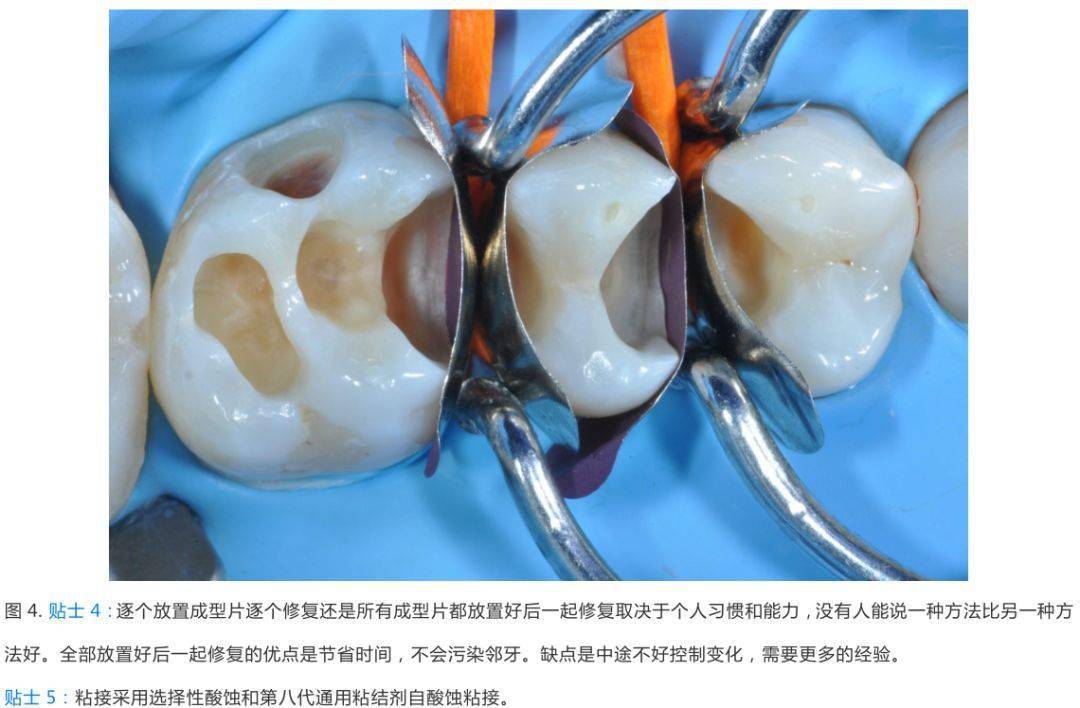 10個後牙直接充填注意點