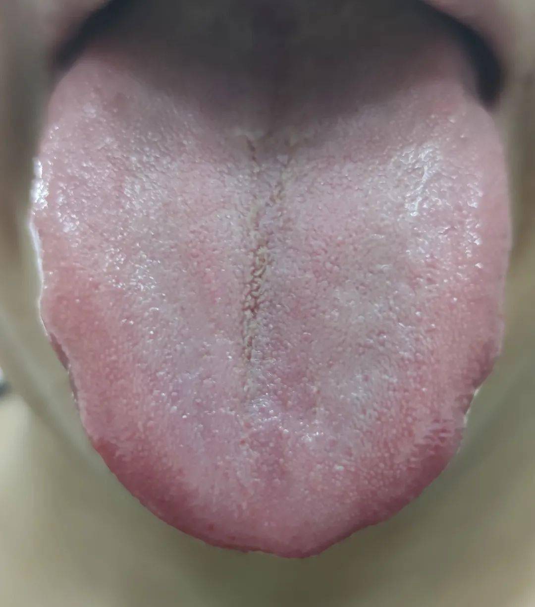舌头的前世今生——望舌质——望舌形（瘦薄舌） - 知乎