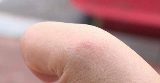 被蚂蚁咬了一口女子街上休克晕倒