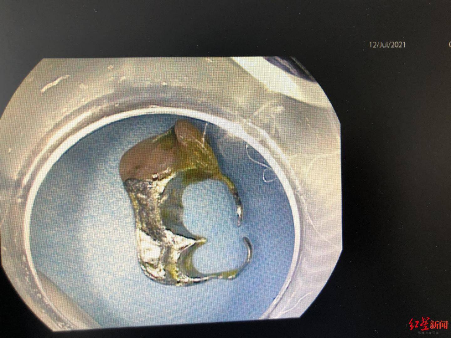 李先生|男子吃橘子时不慎吞入牙套，一个多月后腹部疼痛 医生：进食莫匆忙