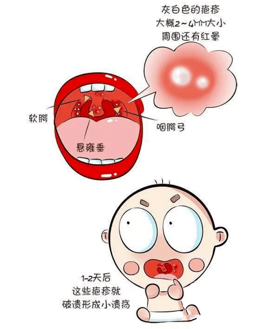 疱疹性咽峡炎是一种常见的急性上呼吸道感染性疾病,主要由肠道病毒