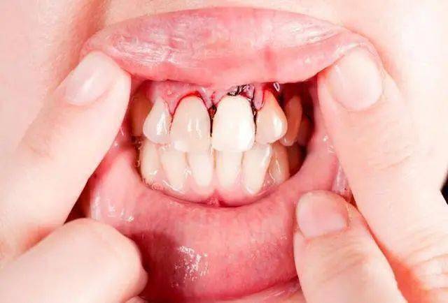 解析梦境,经常梦见满嘴牙都掉是怎么回事? 解析梦境,经常梦见满嘴牙都掉是怎么回事?