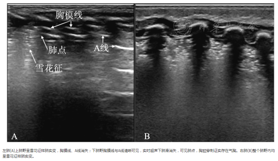 指南与共识新生儿呼吸窘迫综合征超声诊断与分度专家共识