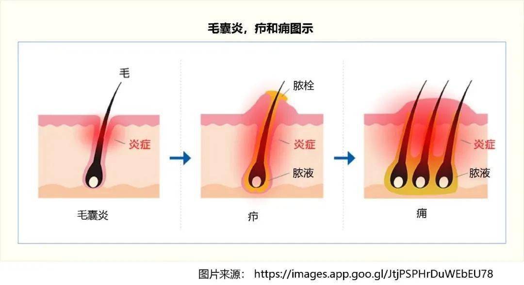 背部长痈的图片图片