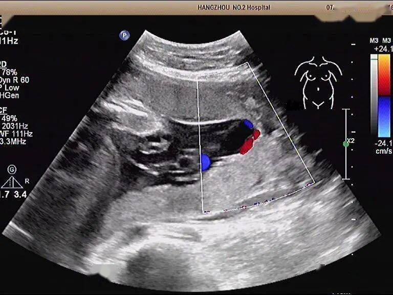 一文带你了解典型的副胎盘_子宫