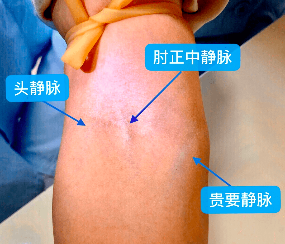 首选手臂肘前区静脉,优先顺序依次为正中静脉,头静脉及贵要静 ..