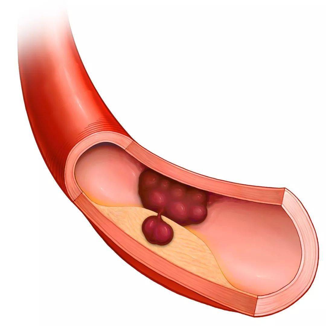 血栓最爱"栓住"五种人,牢记四要素,预防胜于治疗_血管