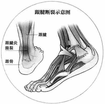 張蓓雯跟腱斷裂含淚退賽這個傷病幾近葬送了頂級運動員們的職業生涯