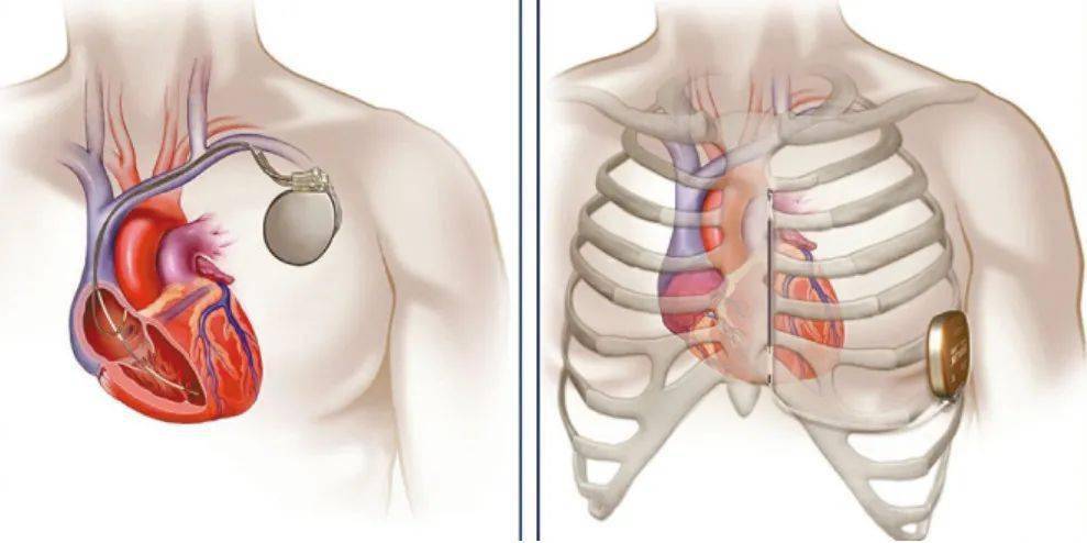 起搏器安放的位置图图片