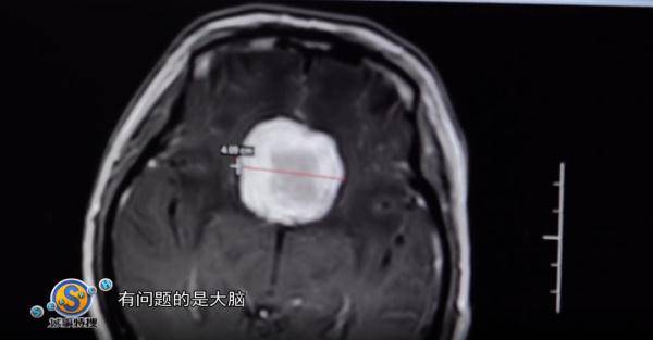 視力|廣東一女子眼睛“起霧”險喪命，一查驚呆，竟是腦中長了個…