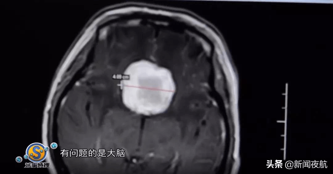 视力|女子眼睛“起雾”险丧命，一查惊呆，问题竟出在脑部