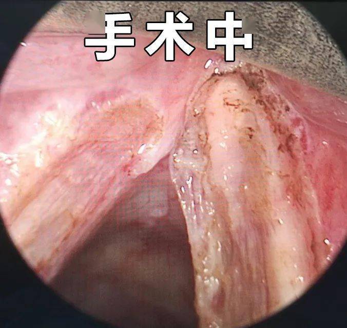 术后喉内镜复查,余大伯的喉咙恢复很好,生活质量也没有受到影响