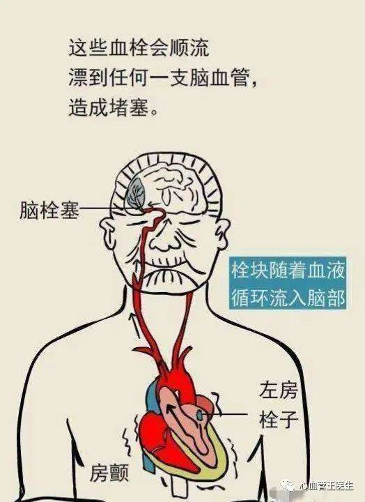 达比加|5个脑梗就有1个是心脏病引起的？您知道吗？应该怎么办？