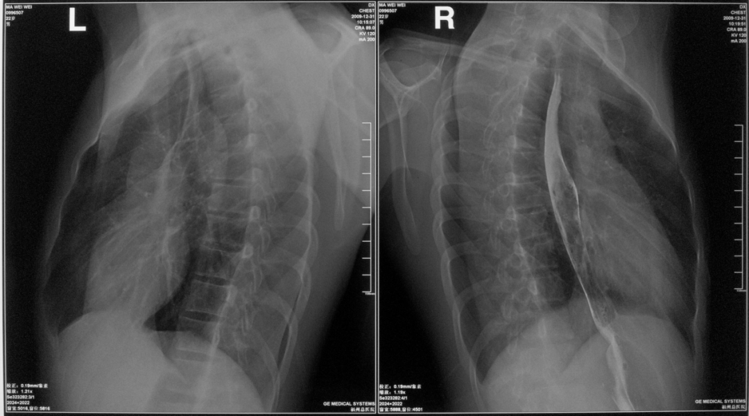胸部右侧位片胸部正侧位片正常心影可见五个弓,纵隔的范围上自胸廓