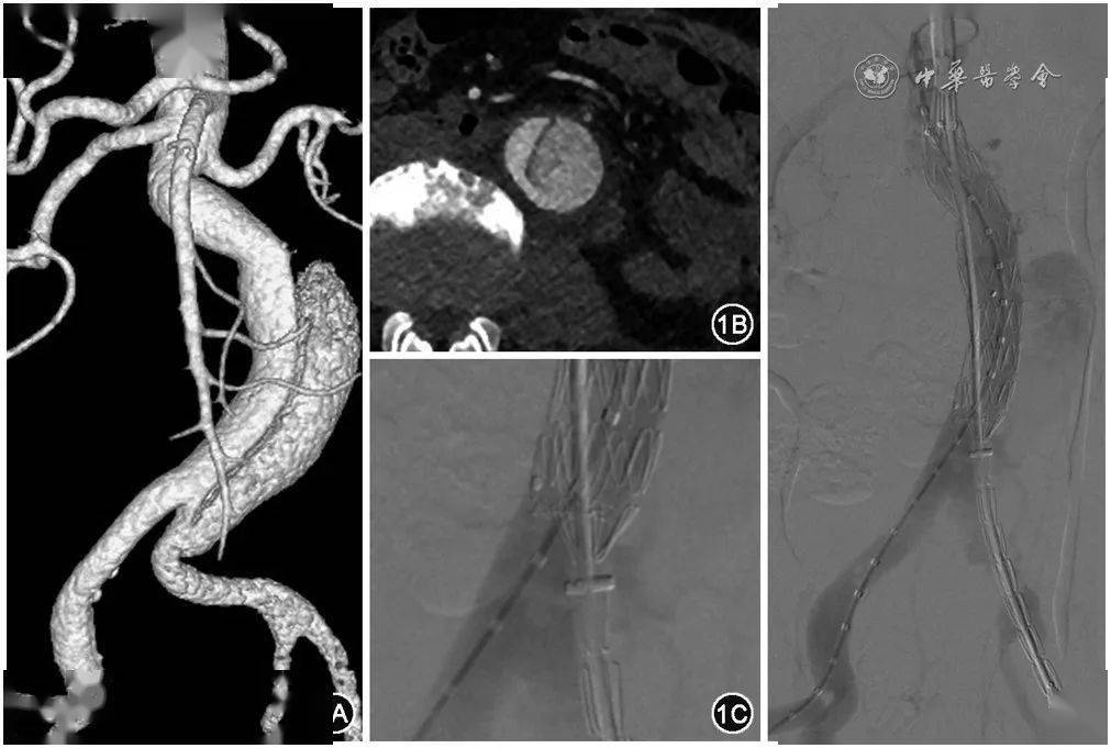 王暾孤立性腹主动脉夹层的腔内修复治疗