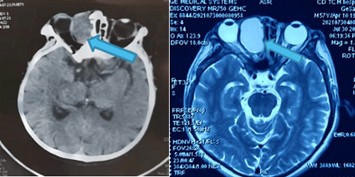 眼眶|眼科大咖领衔，爱尔眼科成都三院联合为患者拆除眼眶“炸弹”