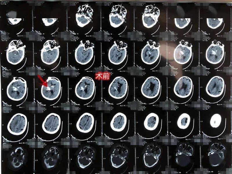 宝鸡第三医院高级卒中中心创建典型病例脑出血篇