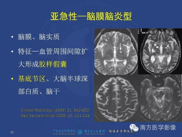 新型隱球菌腦炎影像