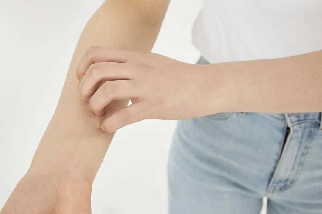 一到夏天皮肤就痒痒痒?4招应对夏季常见皮肤病