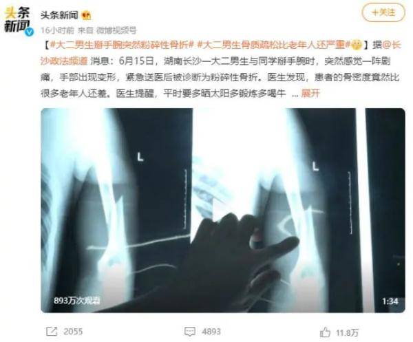 骨骼|大二男生掰手腕时粉碎性骨折！你的骨头没想象的那么“硬”
