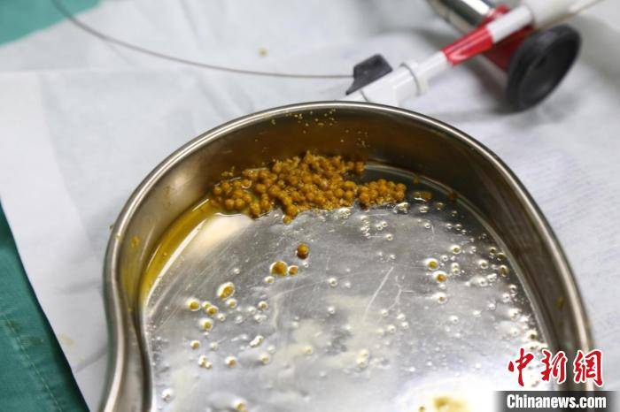 四川|成都某医院收治多名低龄胆结石患者 专家：生活饮食习惯不当导致