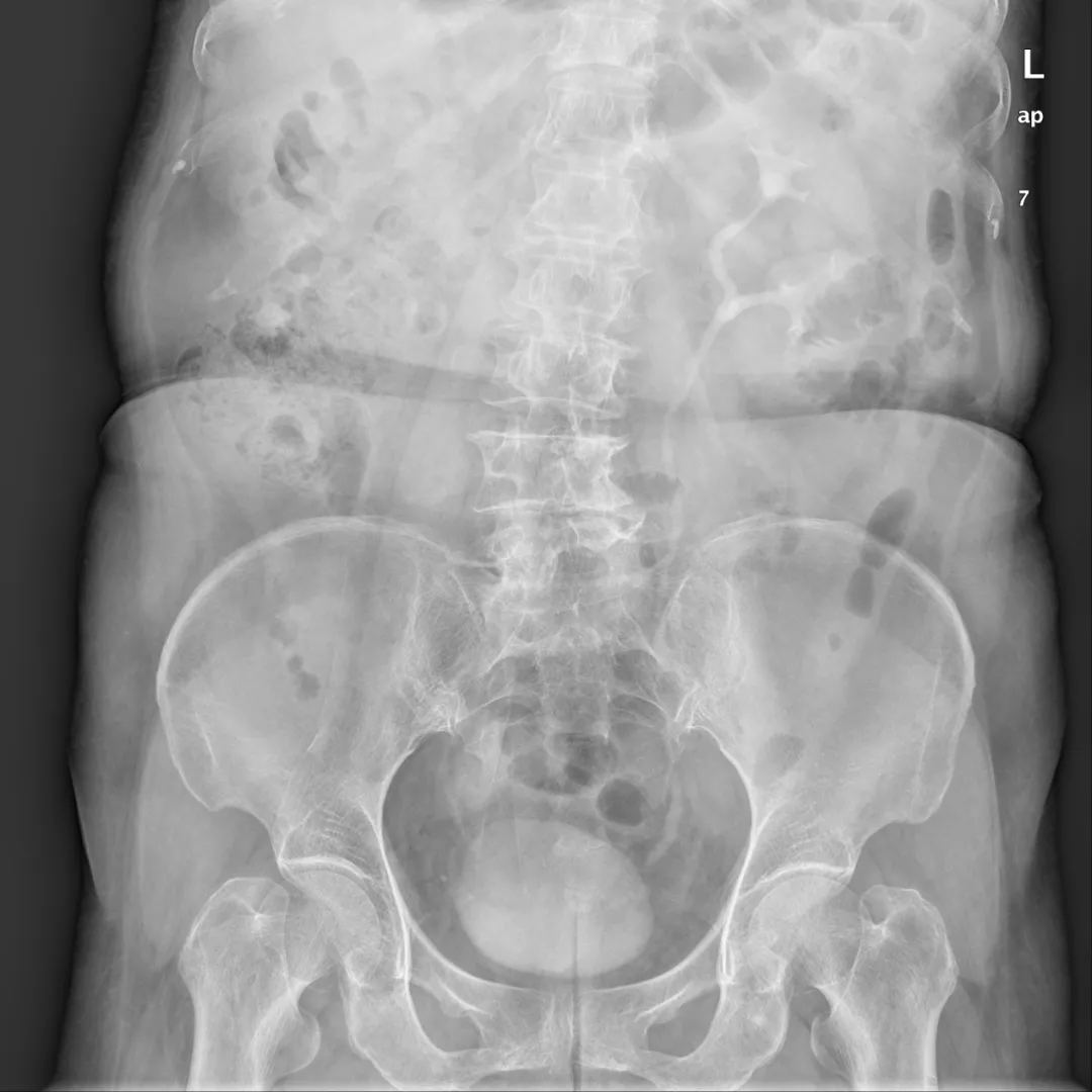 这类患者不要误诊为肾积水