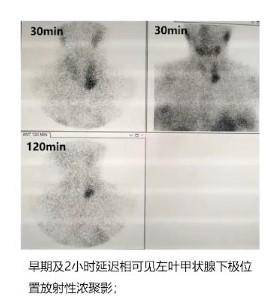 稳态|朱大龙教授：临床应如何应对妊娠并发原发性甲状旁腺功能亢进症？