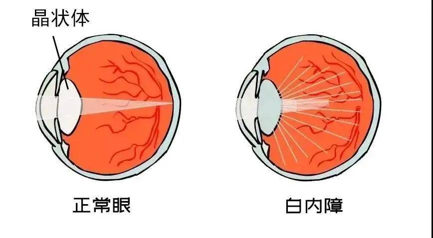 白内障示意图图片