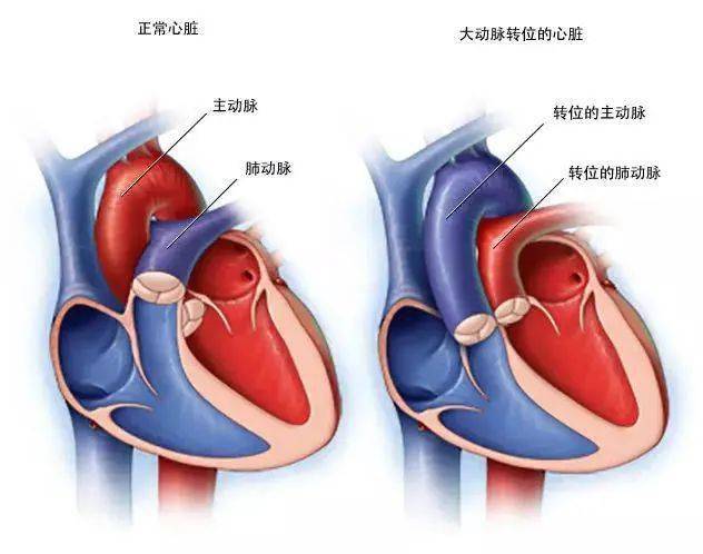 乾坤大挪移新生宝宝主动脉肺动脉位置对调手术如在鸽子蛋上雕花
