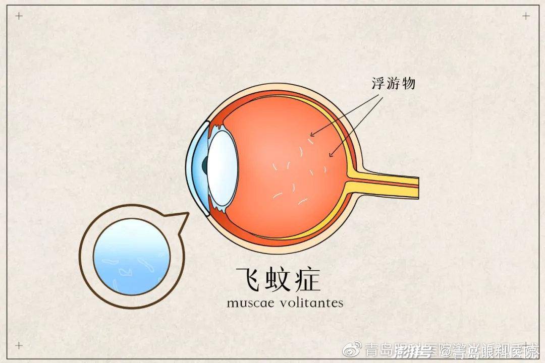 视网膜|视网膜上破了个洞？这种治疗方式简单有效