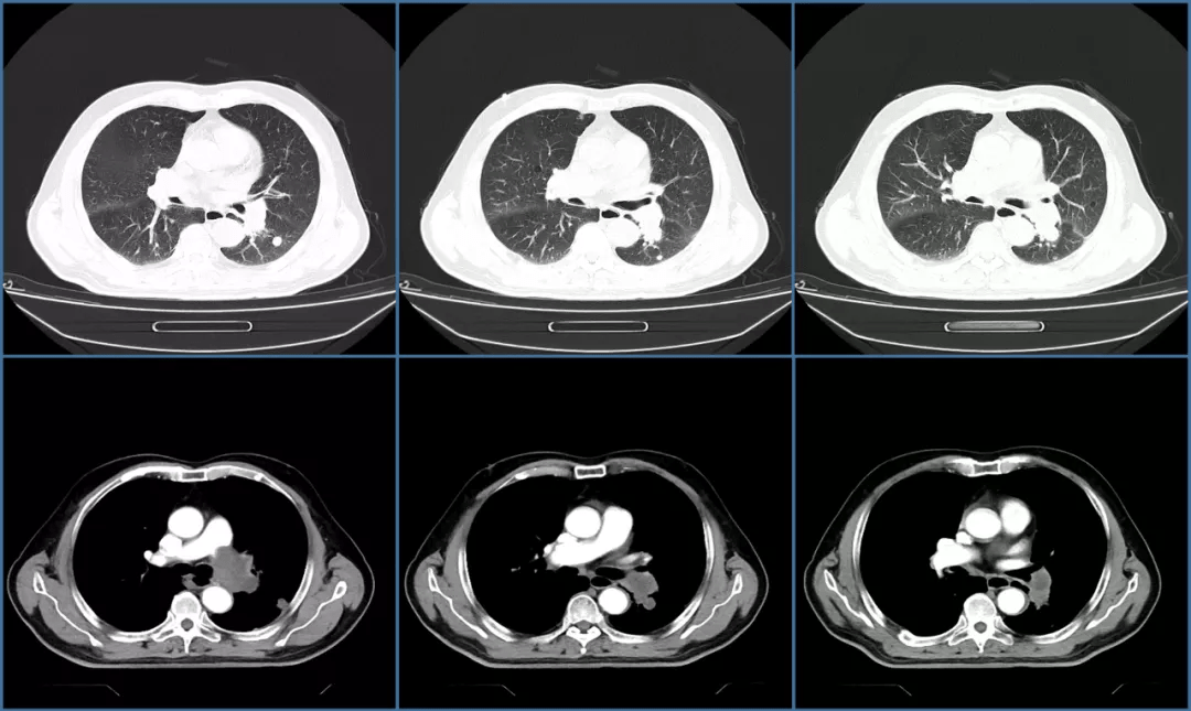 这样的充盈缺损是肺栓塞