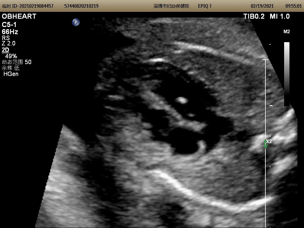 第一步我们要明确什么是左室强光点(echogenic intracardiac focus