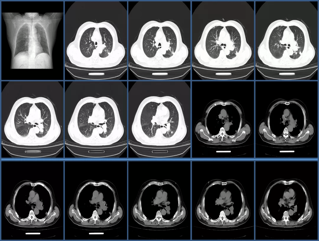这样的充盈缺损是肺栓塞