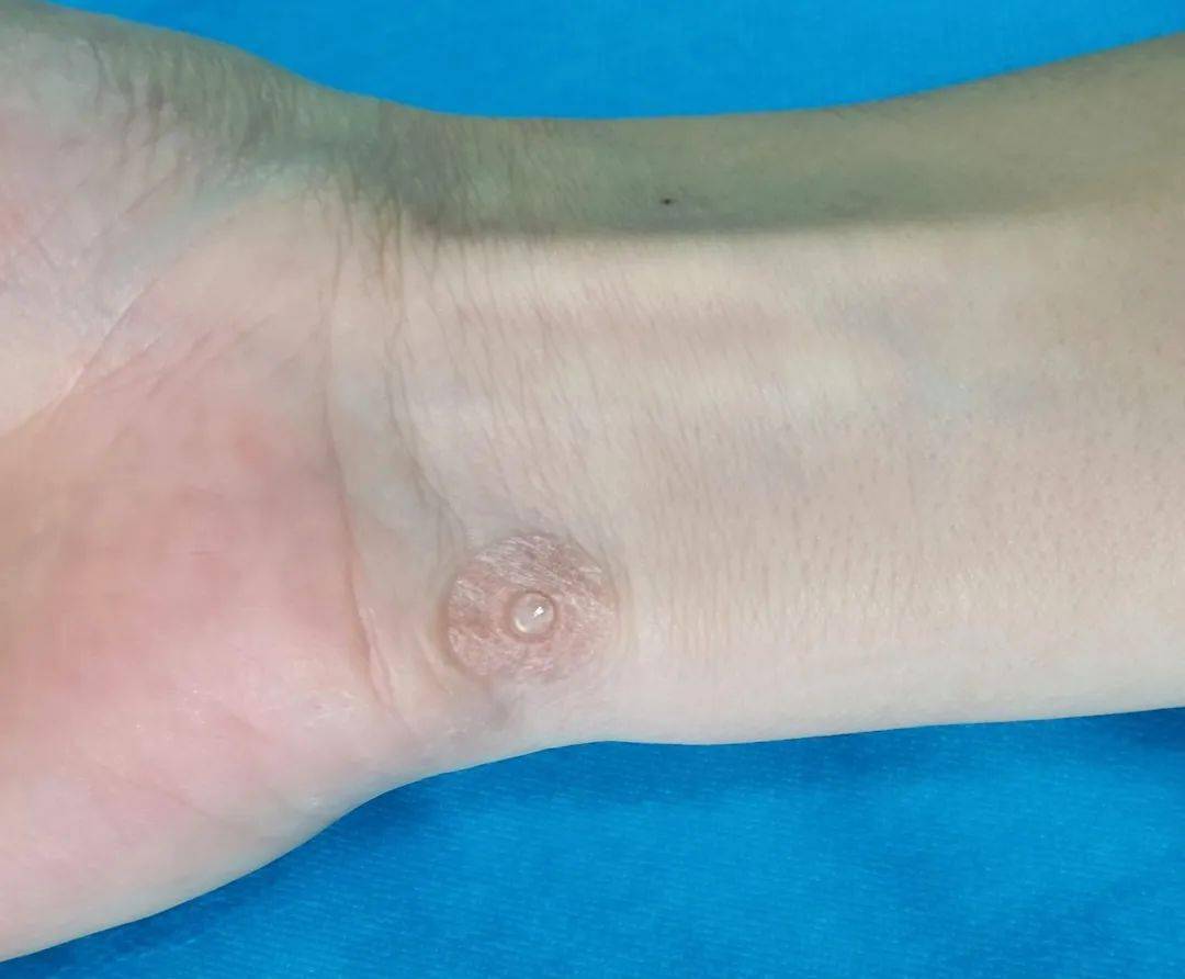 而是中医疗法中的揿针法,它属于微型针灸,形状类似于图钉,为皮内针