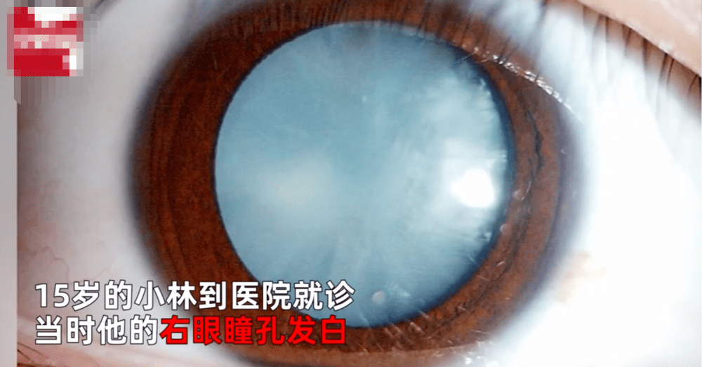 也就是2021年8月3日,浙江杭州某媒体报道,一个15岁的男孩右眼瞳孔全白