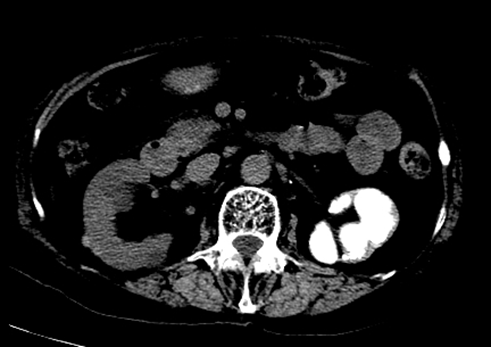 肾结核影像图片