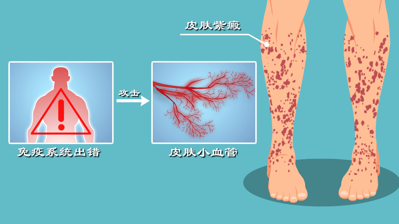 四肢長疹子咋回事免疫失衡過敏硬核動漫過敏性紫癜來歷