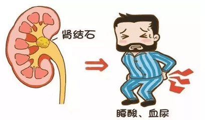 肾结石手术要不要去大医院 3116c76276214fb6aa650d48e08b8f3e.png